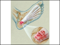 Plantar Fasciitis or Heel Spurs