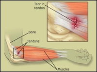 Tennis Elbow